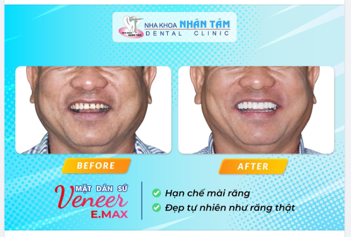 MẶT DÁN SỨ VENEER E.MAX – HẠN CHẾ MÀI RĂNG, ĐẸP TỰ NHIÊN NHƯ RĂNG THẬT