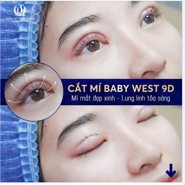Mắt đẹp  Mộng Mơ  - Ưu đãi bất ngờ. Cắt mí Baby West 9D chỉ 8,6trieu