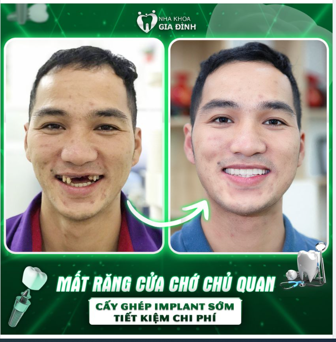 MẤT RĂNG CỬA CHỚ CHỦ QUAN!!!