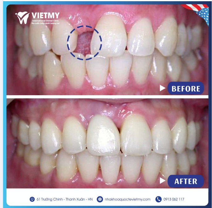 Mất răng cửa sẽ ảnh hưởng đến tính thẩm mỹ rất nhiều, làm thiếu tự tin khi giao tiếp