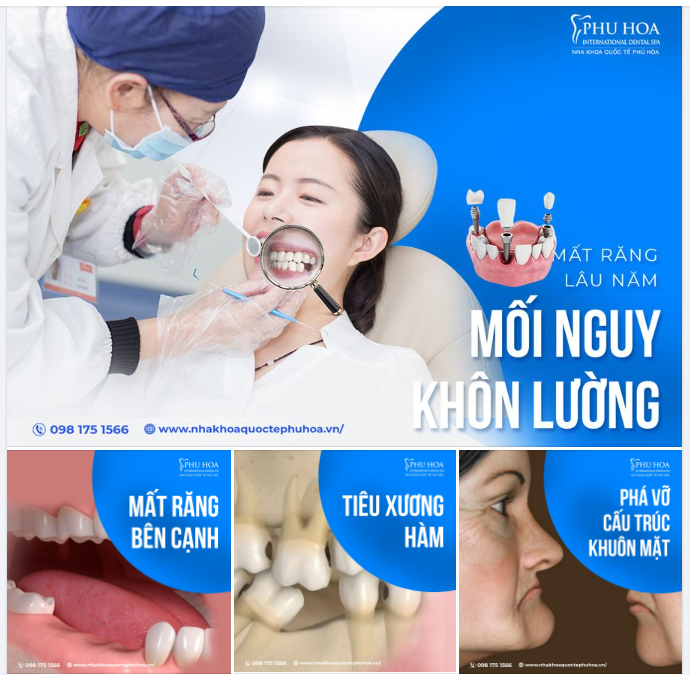 MẤT RĂNG LÂU NĂM – MỐI NGUY KHÔN LƯỜNG!
