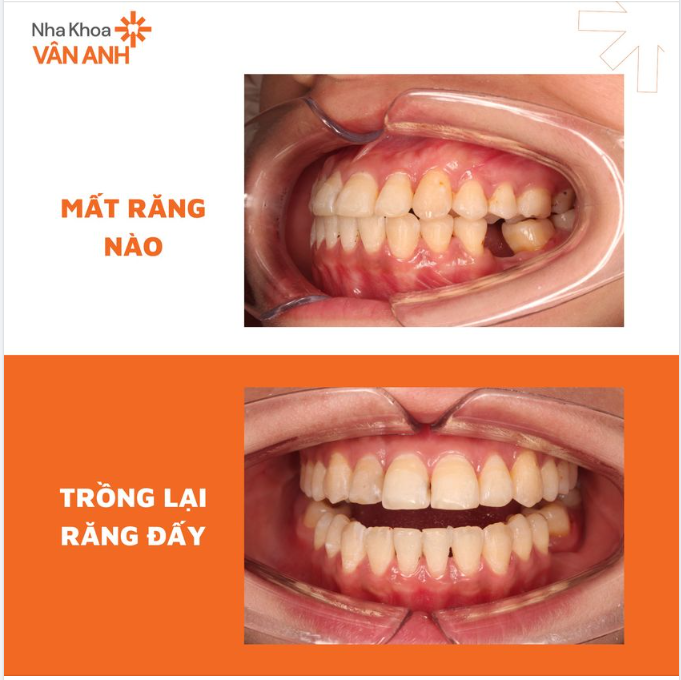 MẤT RĂNG NÀO, TRỒNG LẠI RĂNG ĐẤY