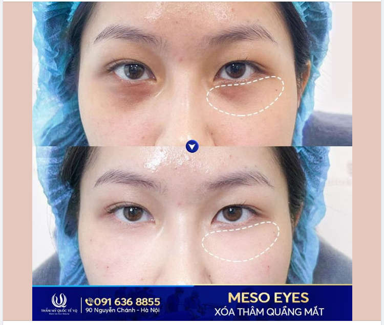 Meso Eyes - Trẻ hóa mắt thần tốc không xâm lấn