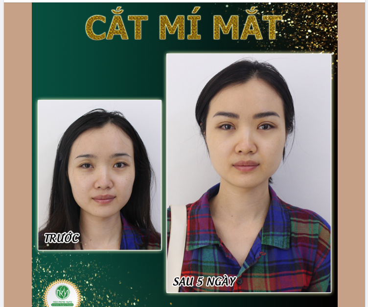 MÍ MẮT ĐẸP SAU 5 NGÀY CẮT CHỈ