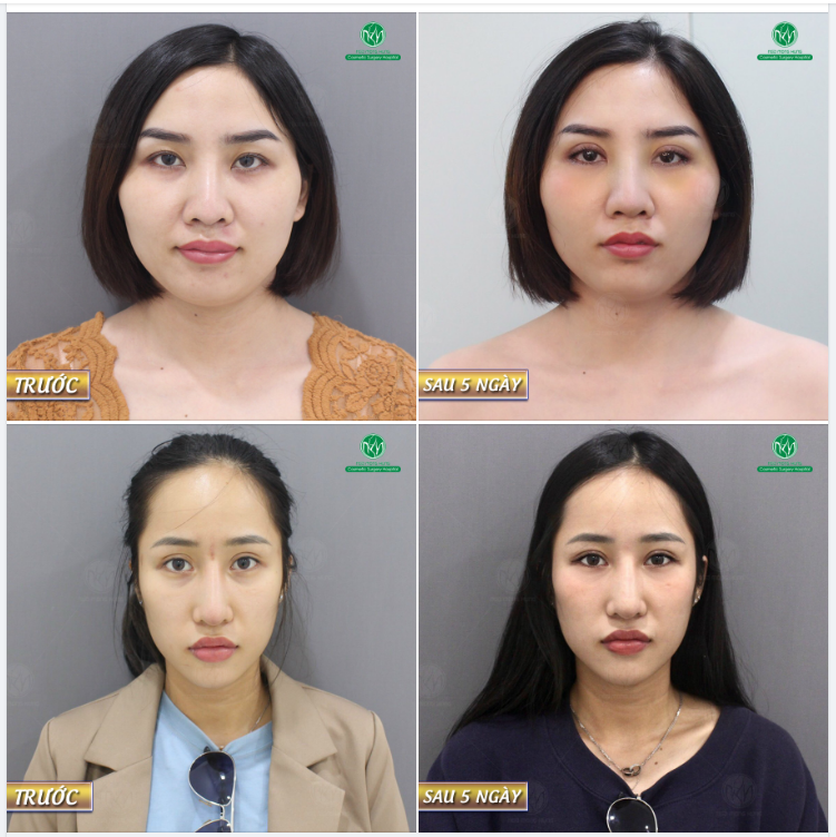 MÍ MẮT KHÔNG RÕ CẮT MÍ MẮT NGAY THÔI !!