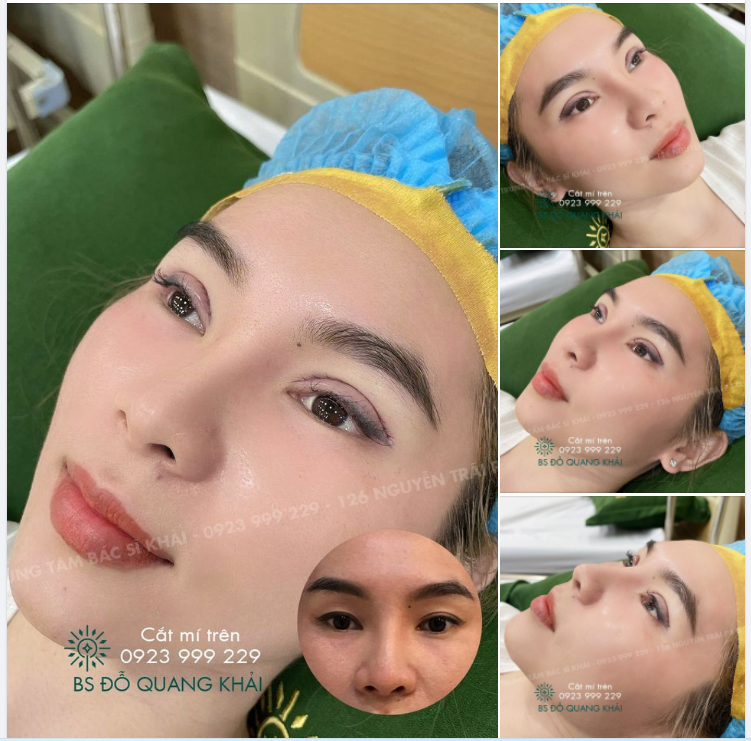 MÍ XINH MỀM MẠI CÙNG bs Đỗ Quang Khải KHÁCH HÀNG LẦN ĐẦU TIÊN CẮT MÍ MÍ BAN ĐẦU BỊ LỆCH, KHÔNG RÕ, BÊN TO BÊN NHỎ