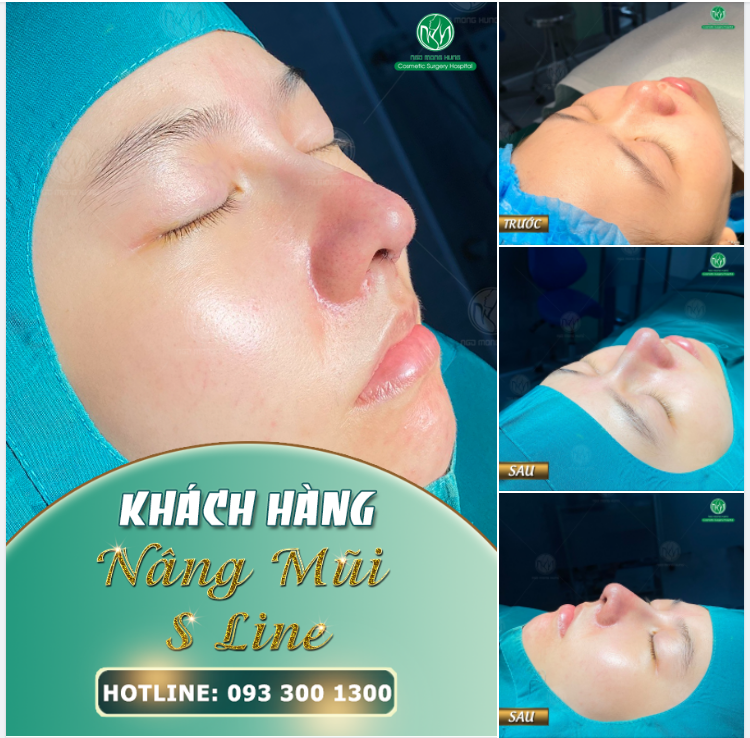 MỖI CA NÂNG MŨI ĐỀU ĐƯỢC THỰC HIỆN VỚI 100% TÂM HUYẾT