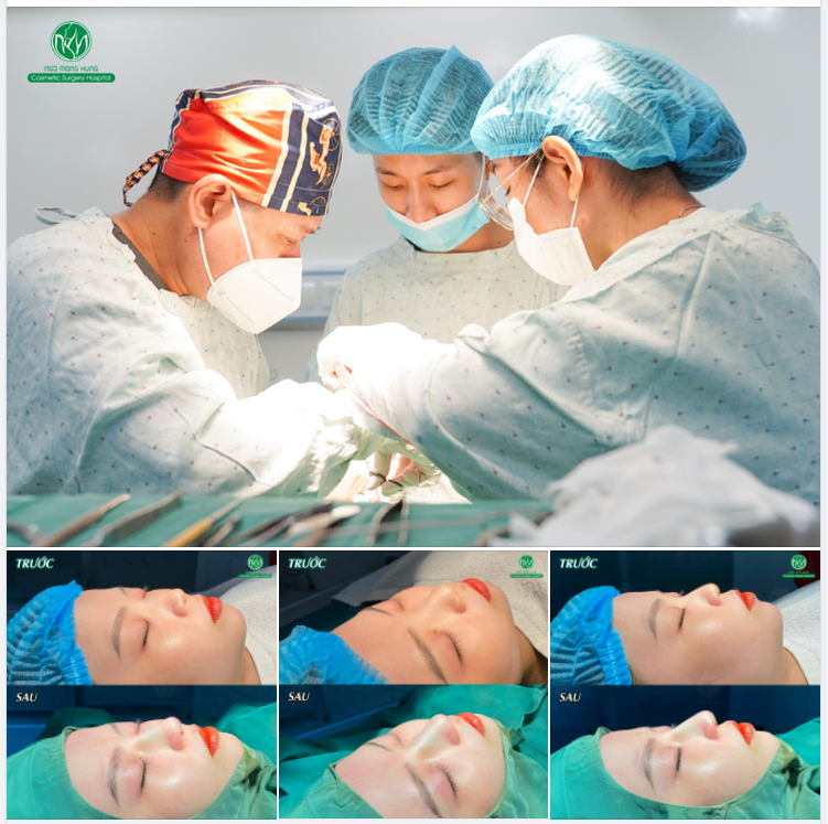 MỘT KẾT QUẢ NÂNG MŨI CUỐI NGÀY