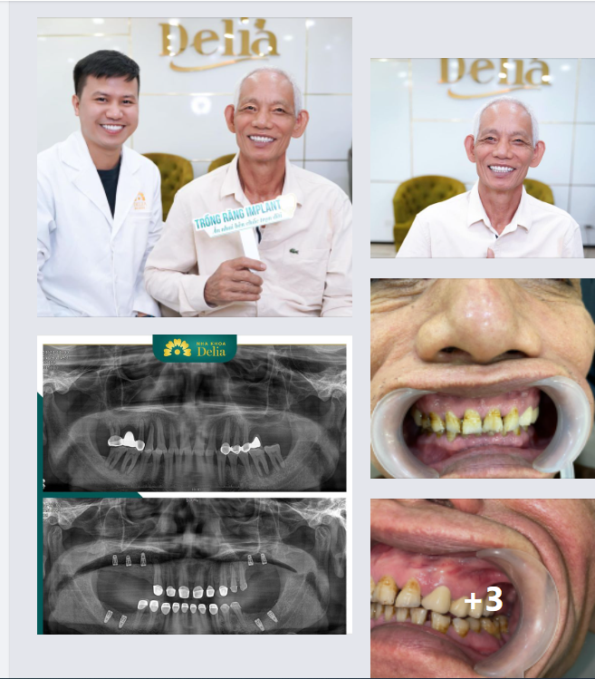 Một khách hàng lớn tuổi cấy 9 trụ răng implant tại Delia.