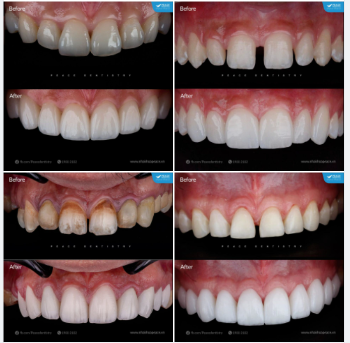 MỘT VÀI GỢI Ý KHI CHỌN MÀU RĂNG SỨ THẨM MỸ