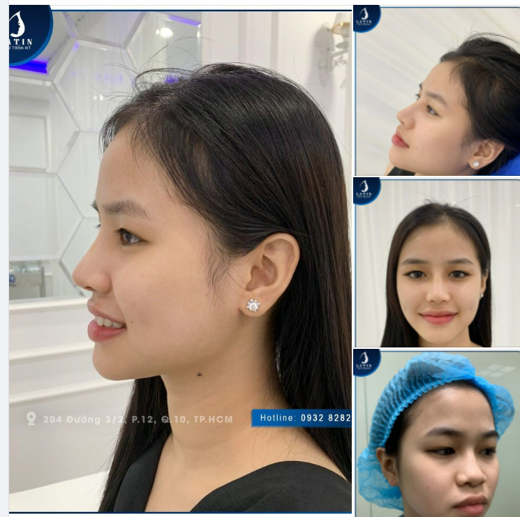 MŨI BÁN CẤU TRÚC LÊN DÁNG CHUẨN FORM