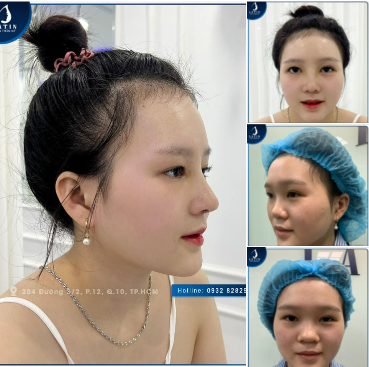 MŨI CẤU TRÚC SAU 10 NGÀY CHO EM GÁI