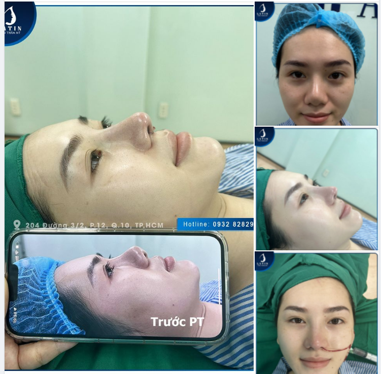 Mũi cấu trúc sửa lại
