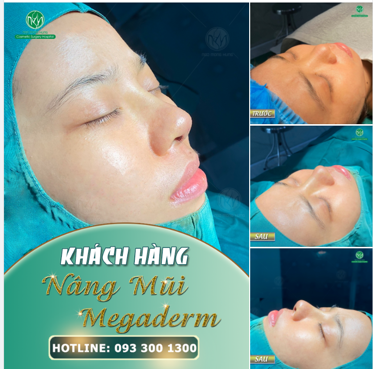 MŨI ĐẸP CHO BUỔI SÁNG THỨ 3