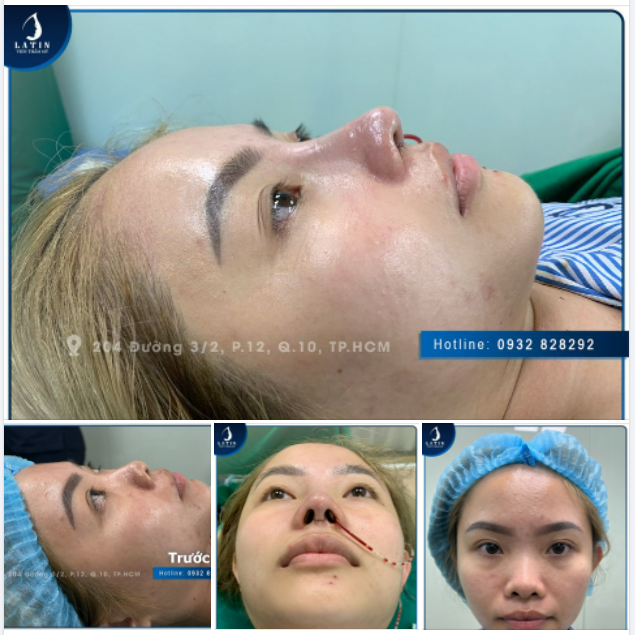 MŨI ĐẸP XINH - GIÚP BẠN LUNG LINH