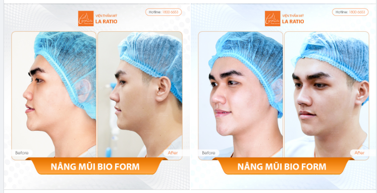 MŨI GỒ ĐƯỢC XỬ LÝ HOÀN HẢO - KHÔNG SƯNG BẦM NHỜ KỸ THUẬT ĐỘC QUYỀN