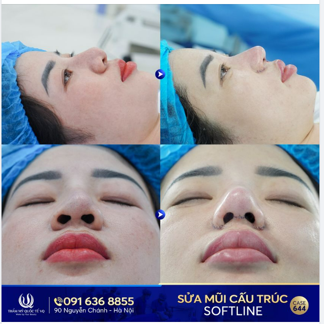 Mũi lệch, biến chứng nặng sau nâng - Sửa lại có lệch thêm lần nữa