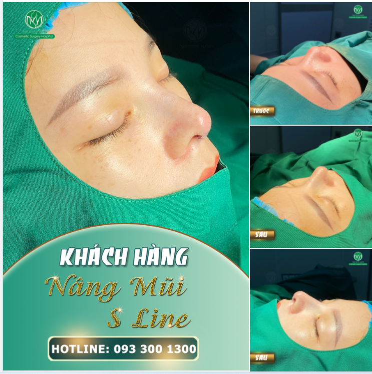 MŨI NHIỀU KHUYẾT ĐIỂM LỰA CHỌN NGAY DÁNG MŨI S LINE