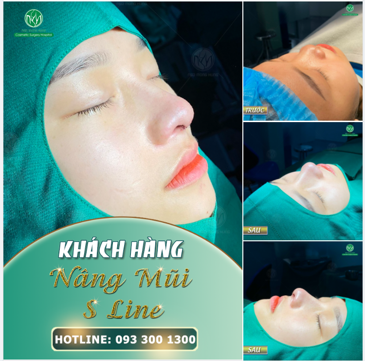 MŨI S LINE VỪA HOÀN THÀNH TẠI PHÒNG PHẪU THUẬT