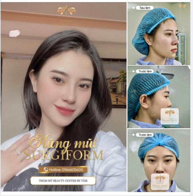 Mũi Surgiform đẹp xuất sắc ngay sau làm
