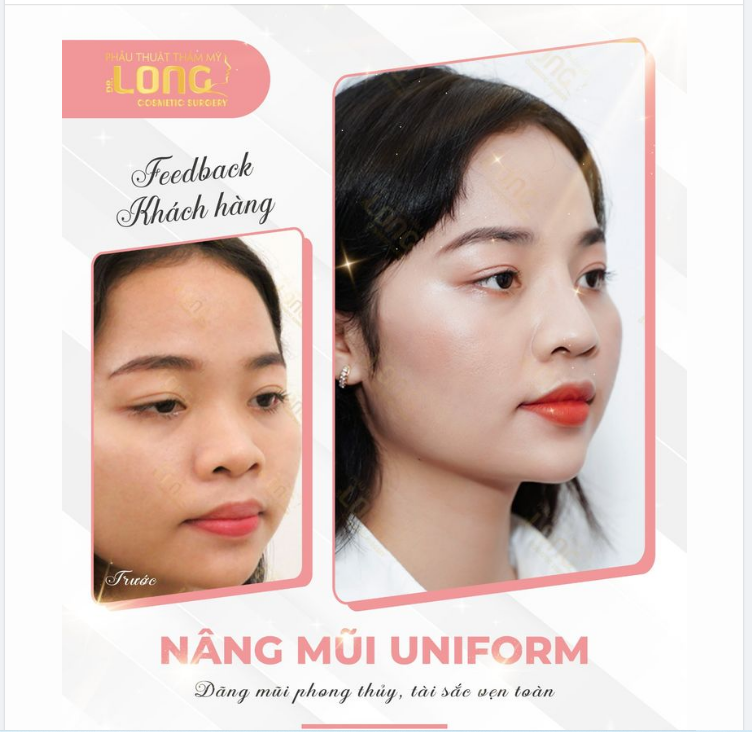 MŨI THẤP TẸT TỚI ĐÂU CŨNG CAO XINH CHỈ SAU 45 PHÚT