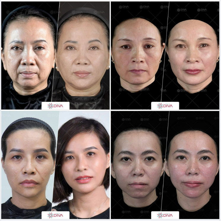 MUỐN LÀM ĐẸP BẰNG TIÊM FILLER, BẠN CẦN BIẾT ĐIỀU NÀY!