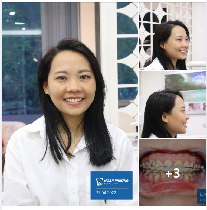 Muốn sang thì bắc cầu kiều - Muốn không hô, móm thì yêu lấy niềng