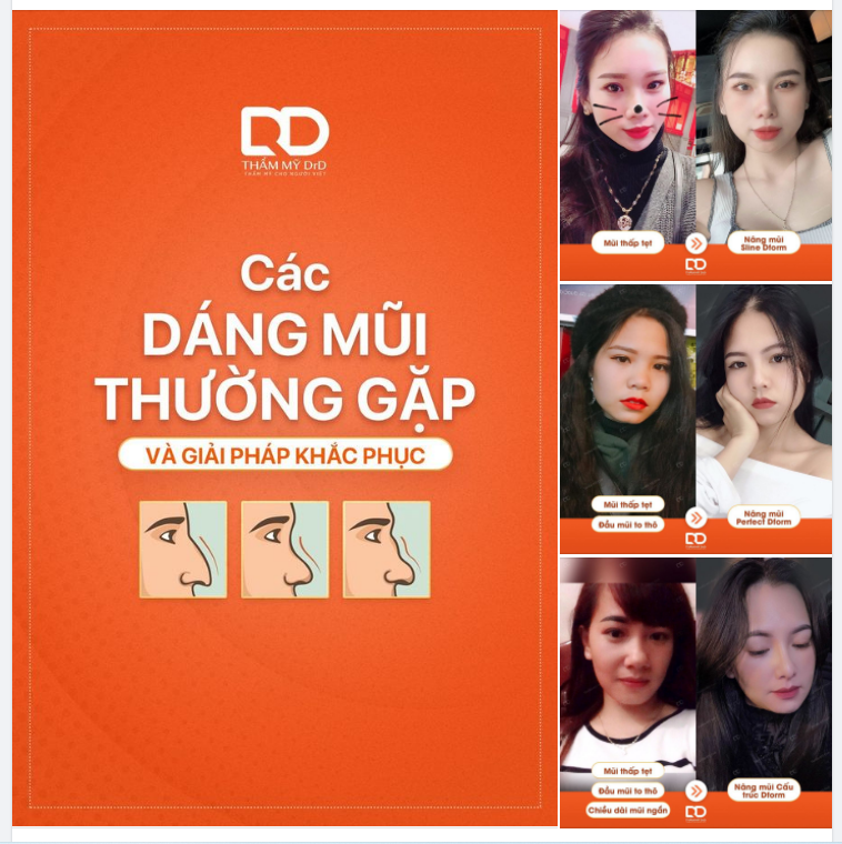 Nàng đang gặp các khuyết điểm trên mũi như thế nào  Sống mũi thấp.  Đầu mũi to. Chiều dài mũi ngắn.