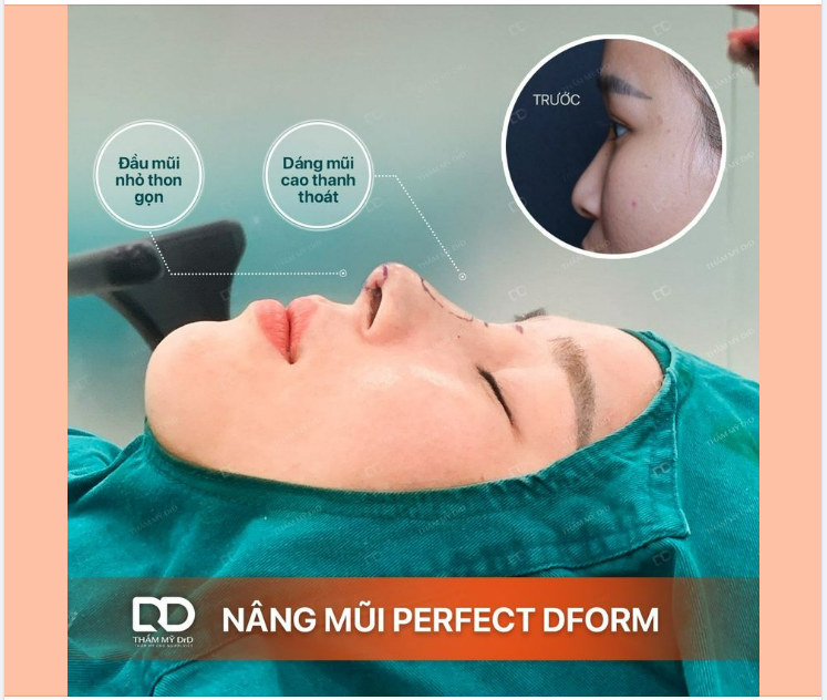 NÂNG MŨI 1 LẦN, ĐẸP ĐƯỢC BAO LÂU