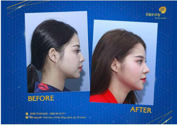 Nâng mũi 4-S 2 lớp - Dáng mũi tự nhiên vạn người mê