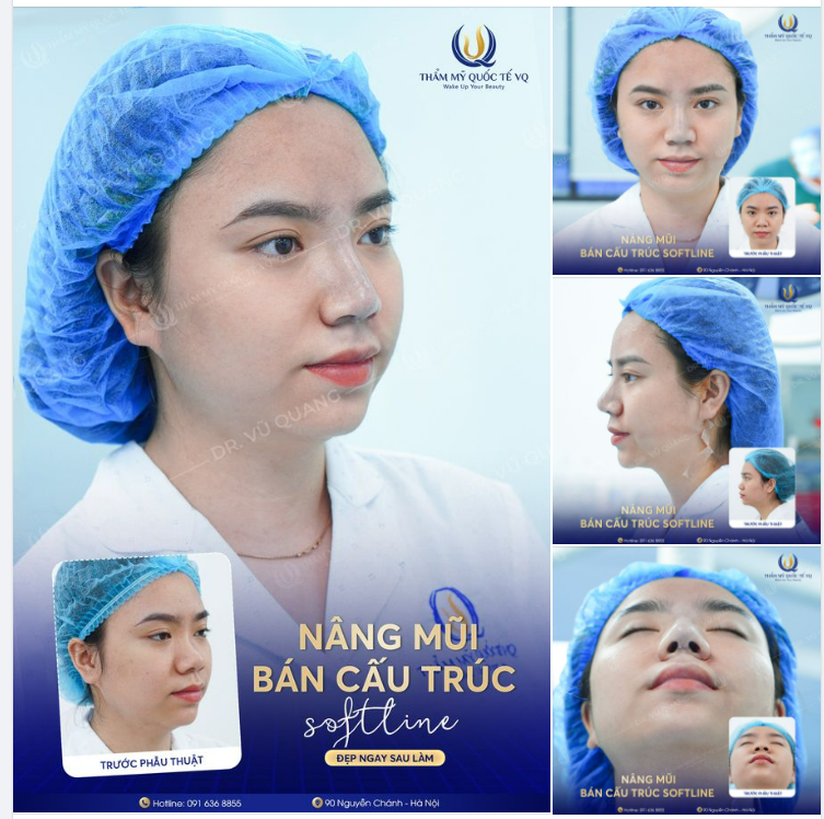 Nâng mũi bán cấu trúc Softline - Khắc phục mũi thấp, hếch và bè cho K.H là cô giáo tiểu học.