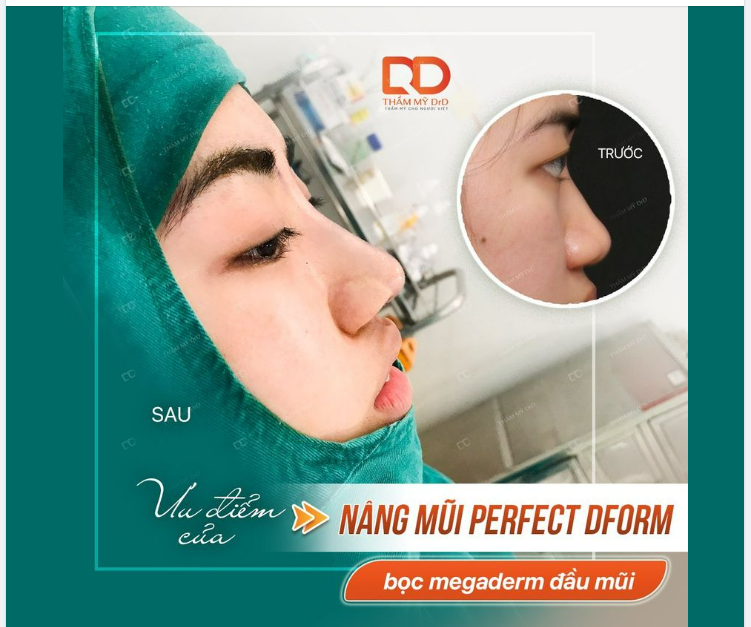 Nâng mũi bọc megaderm đầu mũi có ưu điểm gì