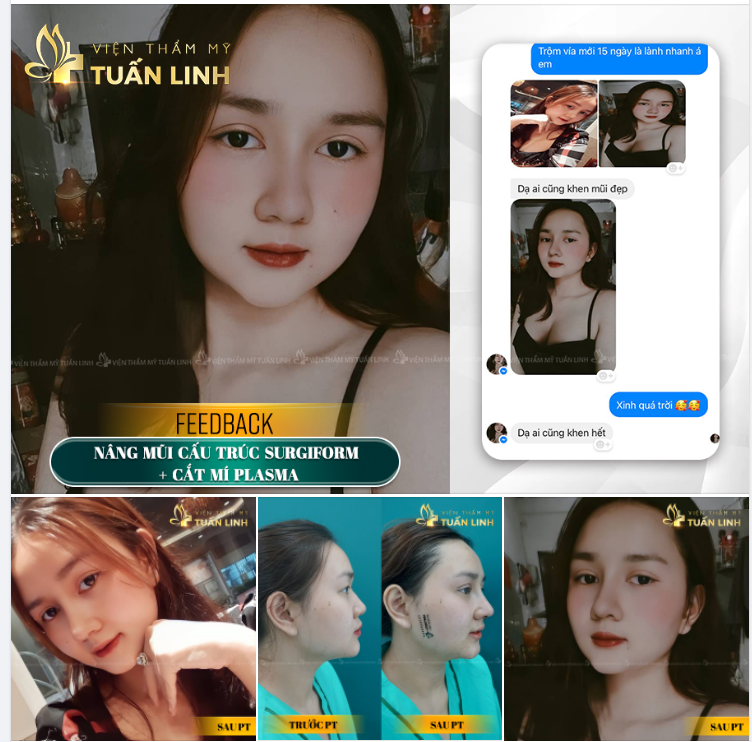 NÂNG MŨI + CẮT MÍ  Feedback xịn sò của khách nhà Tuấn Linh sau 15 ngày phẫu thuật.
