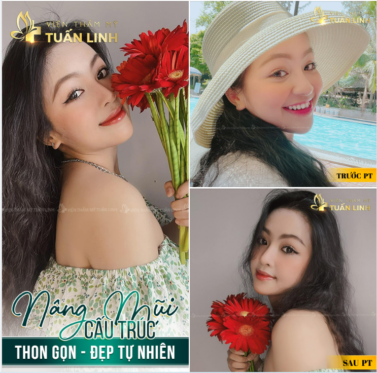 NÂNG MŨI CẤU TRÚC - CHO DÁNG MŨI THON GỌN - ĐẸP TỰ NHIÊN!!!