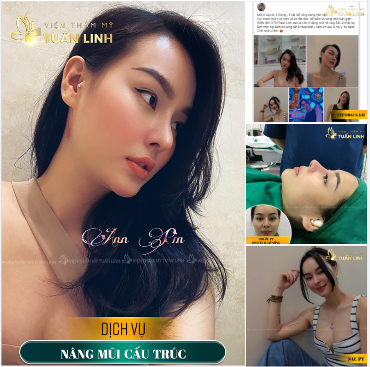 NÂNG MŨI CẤU TRÚC - KHẮC PHỤC HOÀN TOÀN MŨI LỆCH, MÉO, LỘ SỐNG