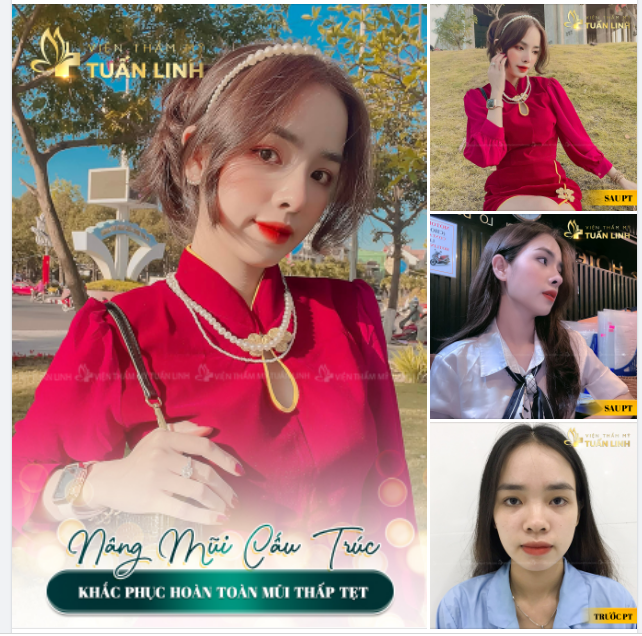 NÂNG MŨI CẤU TRÚC - KHẮC PHỤC HOÀN TOÀN MŨI THẤP TẸT, TO BÈ.