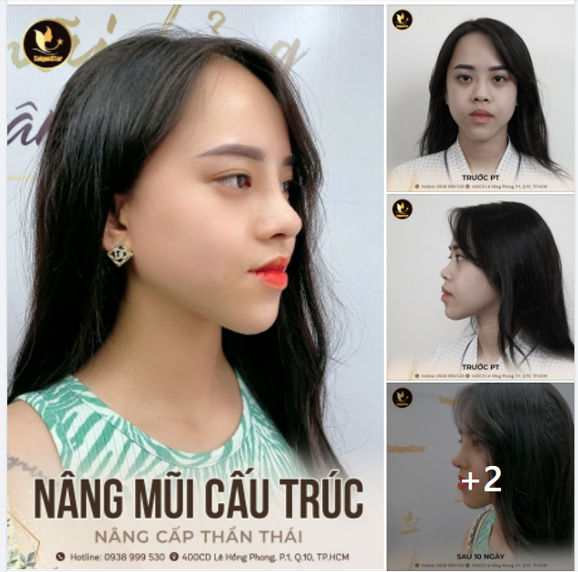 NÂNG MŨI CẤU TRÚC – NÂNG CẤP THẦN THÁI