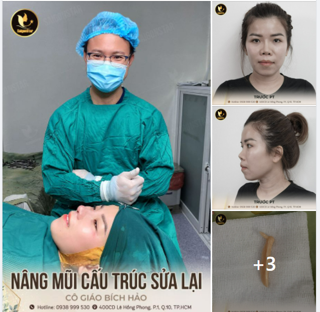 NÂNG MŨI CẤU TRÚC SỬA LẠI – KH BÍCH HẢO