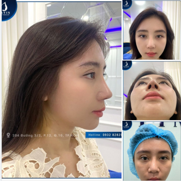 Nâng mũi chỉ - hậu quả khôn lường, nhiều rủi ro. Khách tới tái khám và cắt chỉ sau 10 ngày sửa lại mũi cấu trúc