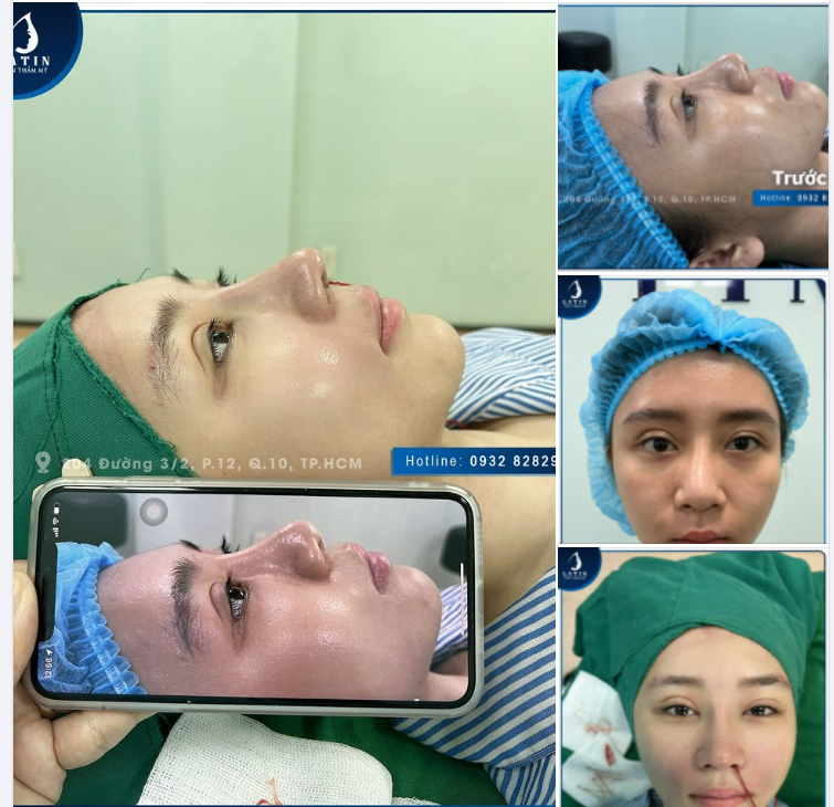 Nâng mũi chỉ, sửa lại cấu trúc có được không 