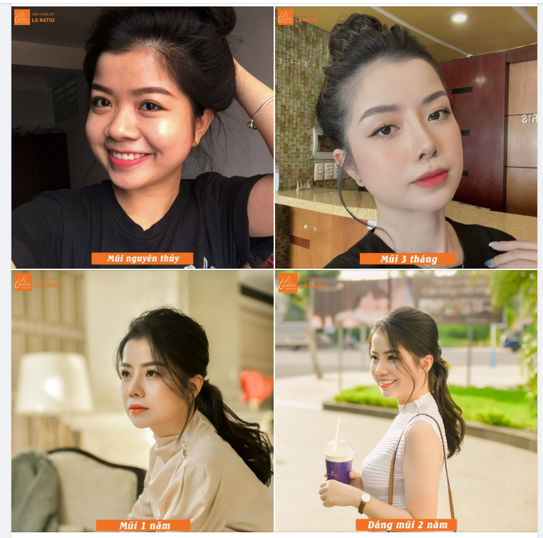 NÂNG MŨI CÓ NHẤT THIẾT PHẢI BĂNG NẸP