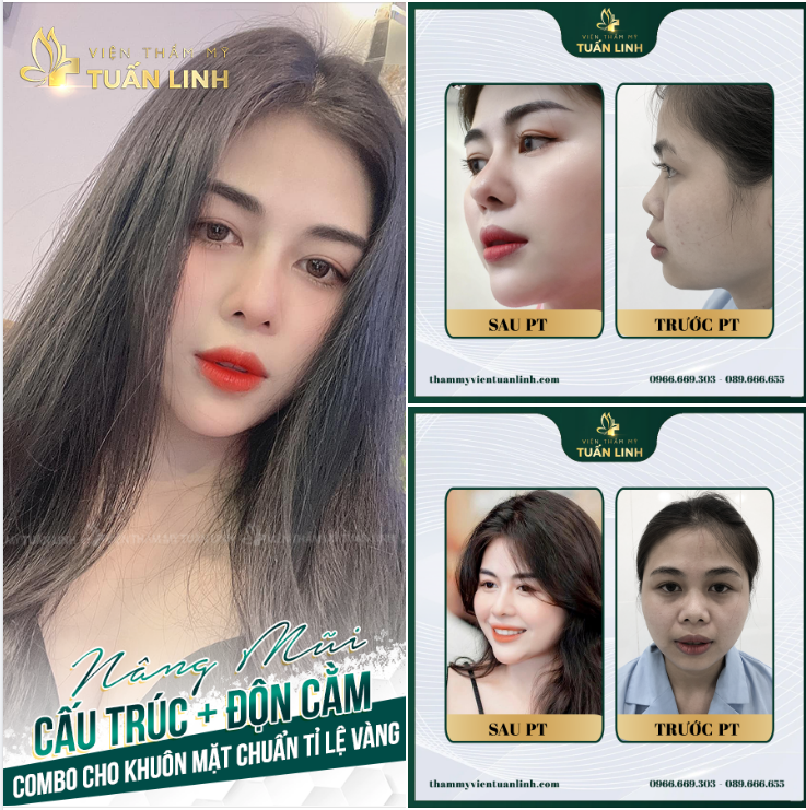NÂNG MŨI + ĐỘN CẰM  COMBO CHO KHUÔN MẶT ĐẸP CHUẨN TỈ LỆ VÀNG