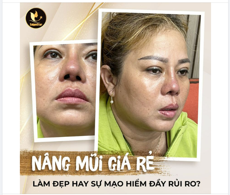 NÂNG MŨI GIÁ RẺ LÀM ĐẸP HAY SỰ MẠO HIỂM ĐẦY RỦI RO