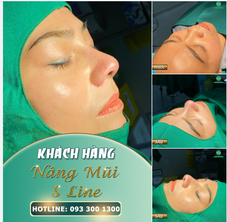 NÂNG MŨI KHÔNG HỀ ĐAU NHƯ BẠN NGHĨ