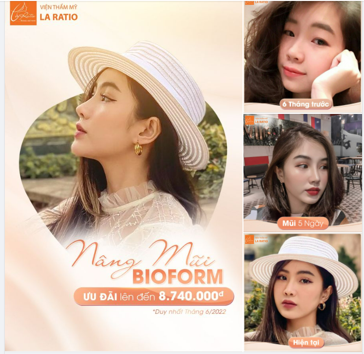 NÂNG MŨI LINH HOẠT TỰ NHIÊN ĐỈNH CAO