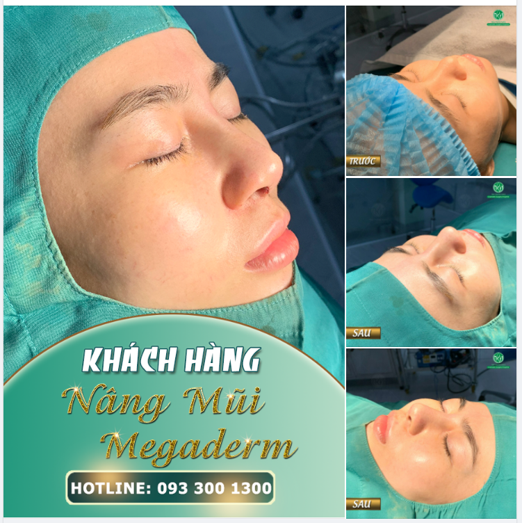NÂNG MŨI MEGADERM AN TOÀN CHI PHÍ HẤP DẪN