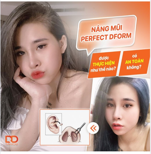 NÂNG MŨI PERFECT DFORM ĐƯỢC THỰC HIỆN NHƯ THẾ NÀO
