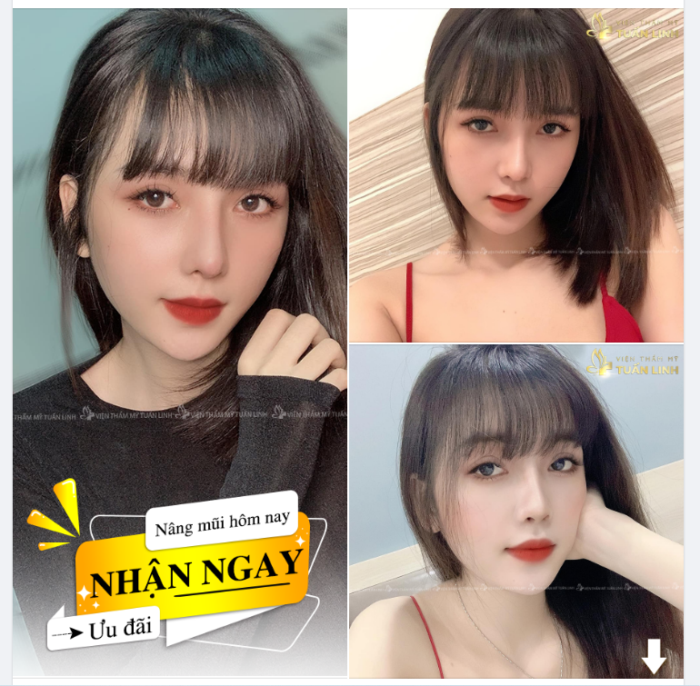 NÂNG MŨI SIÊU CẤU TRÚC.