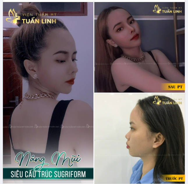 NÂNG MŨI SIÊU CẤU TRÚC