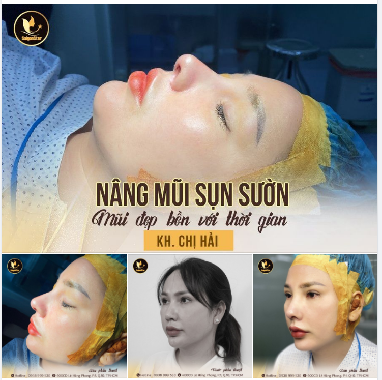 NÂNG MŨI SỤN SƯỜN – MŨI ĐẸP BỀN VỚI THỜI GIAN
